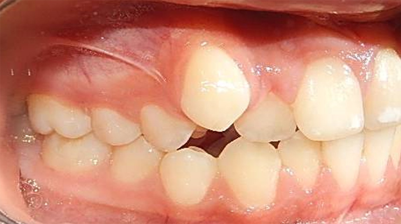 Fig. 3 lateral derecha