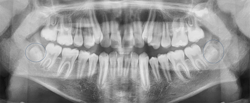 Fig 6. Radiografía Panorámica
