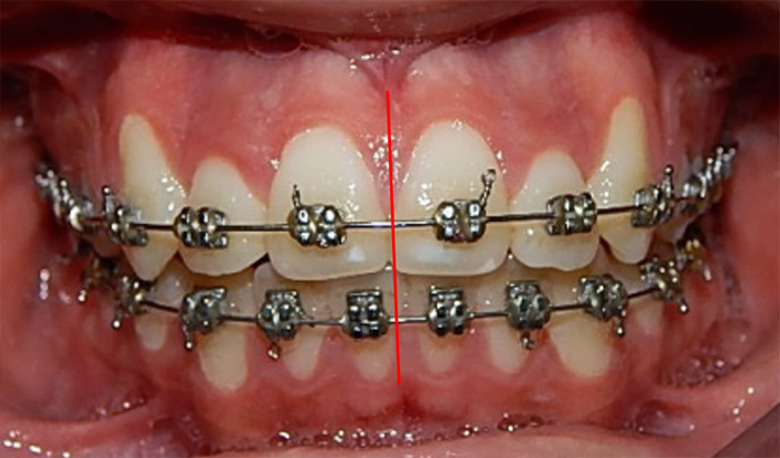 Fig 10. Intraoral de progreso