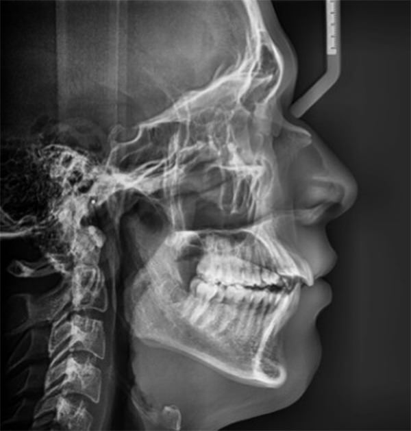 Fig. 1 Radiografía lateral de cráneo