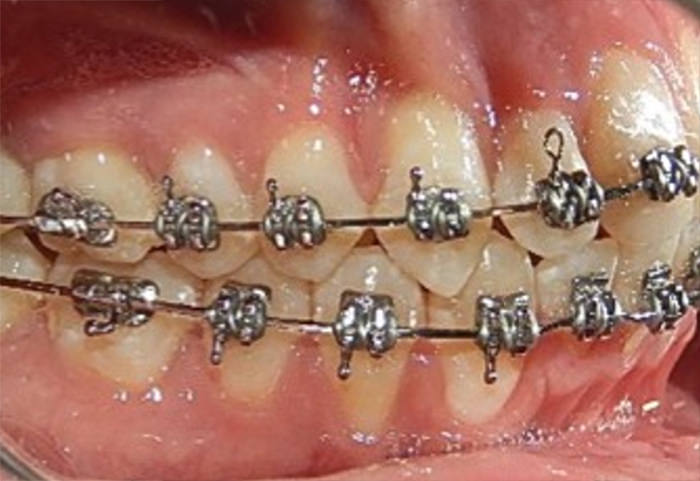 Fig.10 Lateral derecha