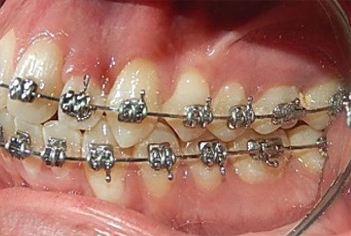 Fig.11 Lateral izquierda