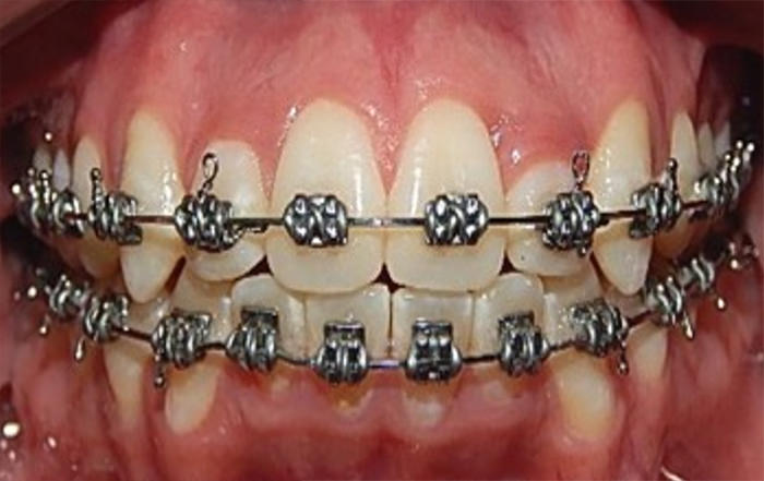 Fig.13 Oclusal superior 