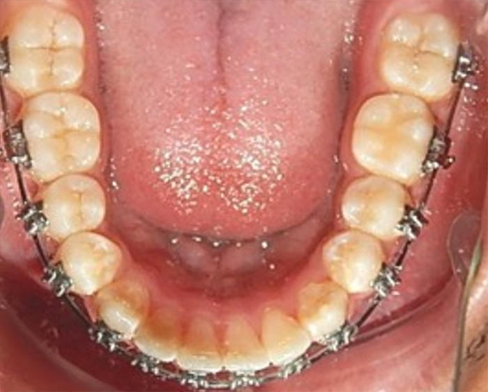 Fig.14 Oclusal inferior