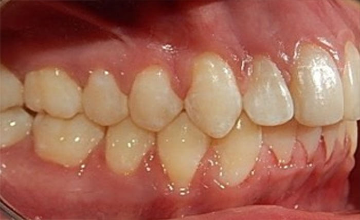 Fig.17 Intraoral derecha