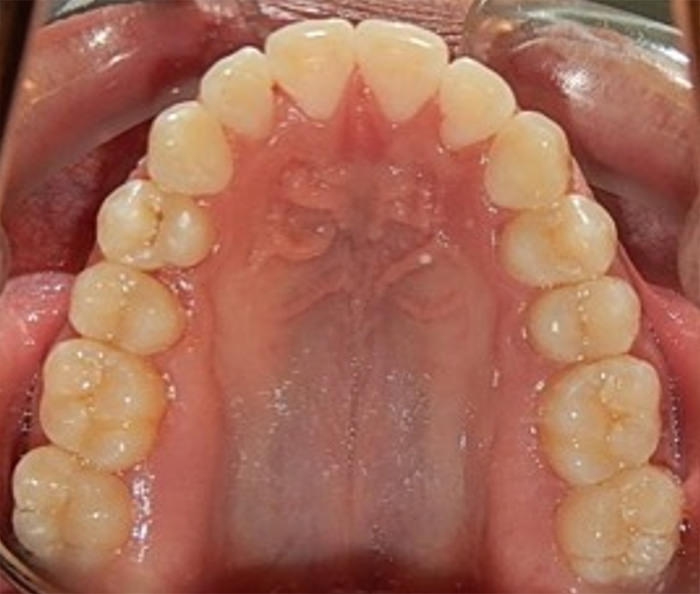 Fig.20 Oclusal superior