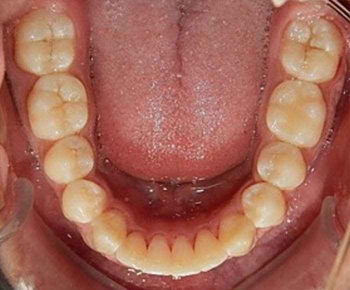 Fig.21 Oclusal inferior