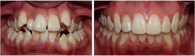 Fig.23 Comparaciones inicio y final intraoral de frente