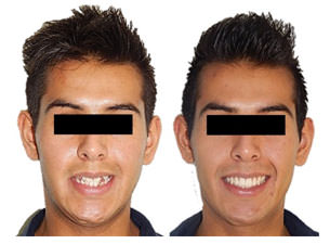 Fig.24 fotografía extraoral comparacion inicio y final l de sonrisa 