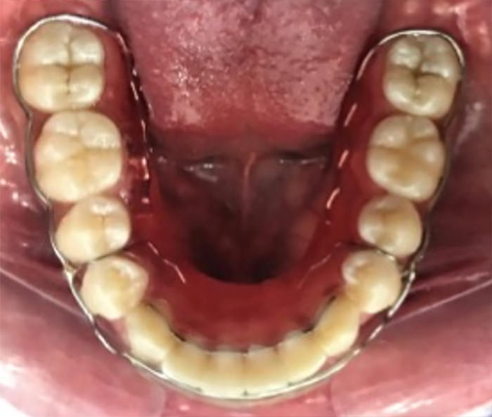 Fig.26 Retenedor inferior