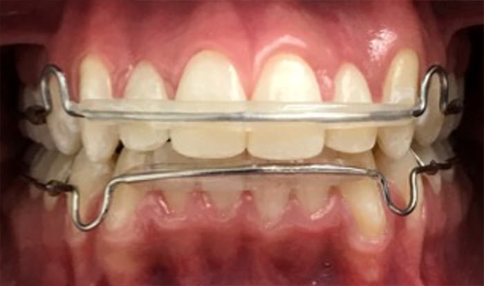 Fig.27 intraoral de frente