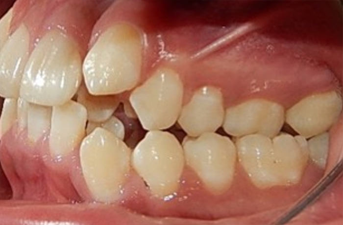 Fig. 4 Intraoral izquierda