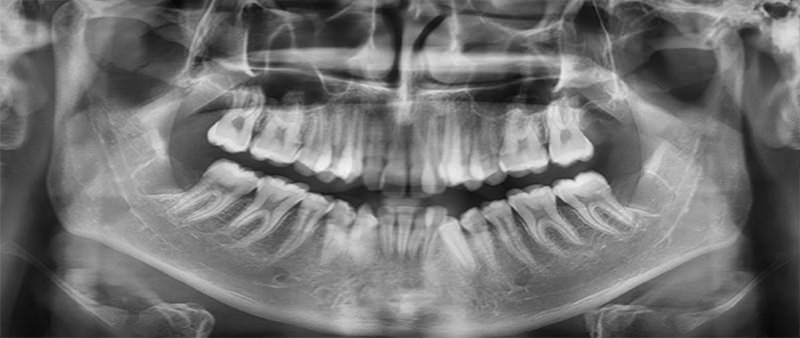 Fig. 8 Radiografía panorámica