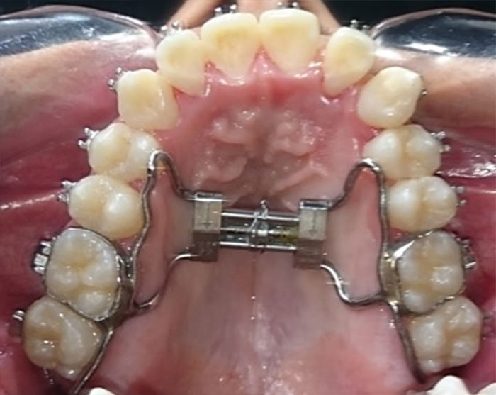 Fig.9 Expansor maxilar tipo Hyrax