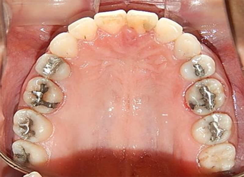 Figura 16. Intraoral oclusal superior