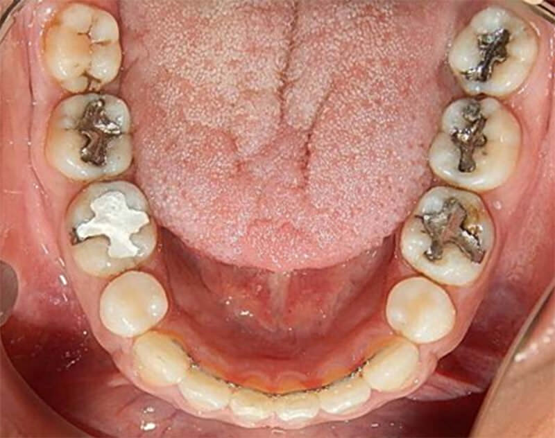 Figura 17. Oclusal inferior