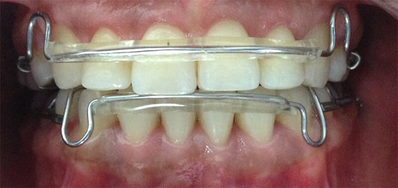 Figura 19. Intraoral con los retenedores