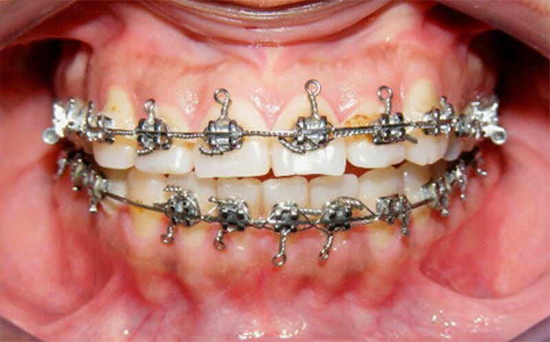 Figura 3. Intraoral de frente de sonrisa