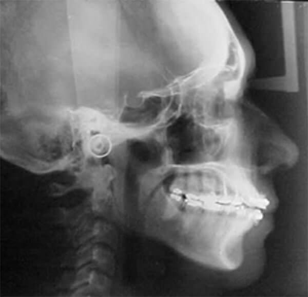 Figura 6. Lateral de cráneo inicio