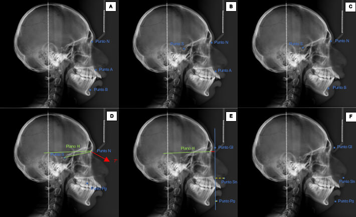 Patrón Esquelético (tejidos duros) – Patrón facial (tejidos blandos)