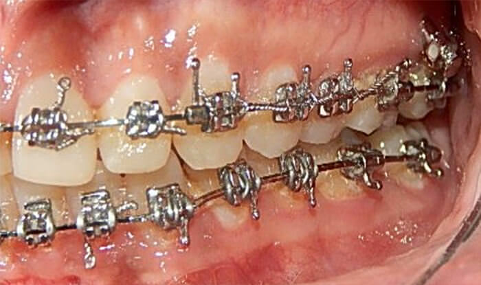 Fig. 16 Lateral  izquierda