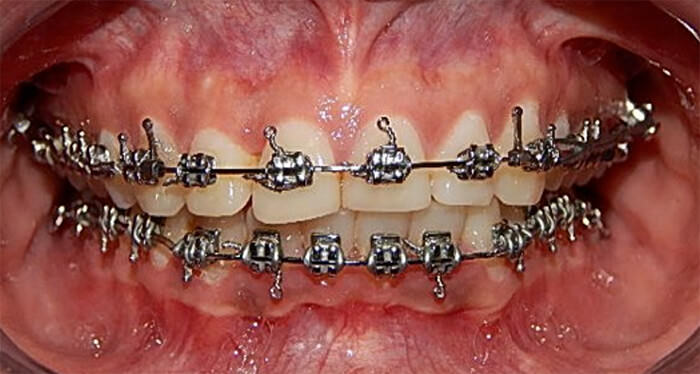 Fig. 17 Intraoral progreso frente