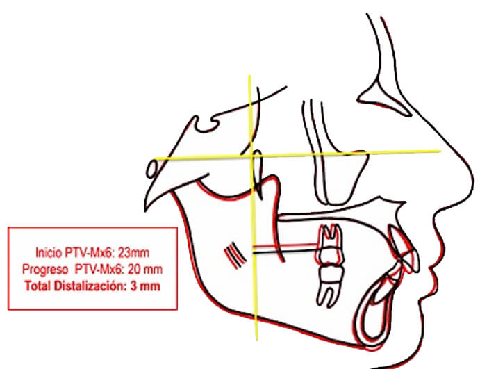 Fig. 23 Distalizacion