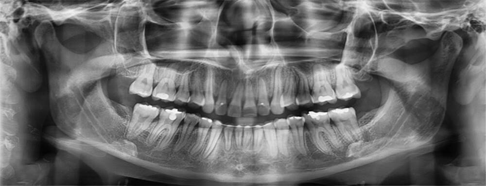 Fig. 24 Rx Panoramica final