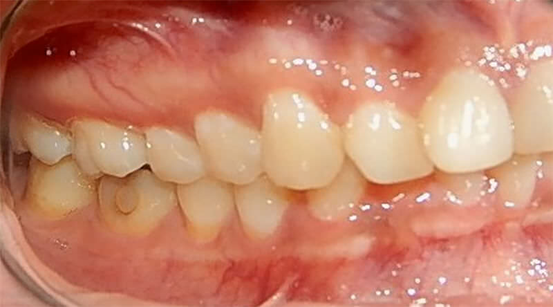 Fig. 5 Lateral derecha