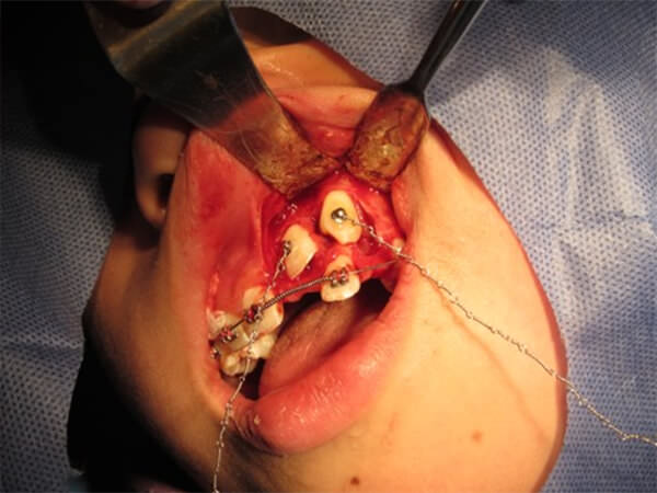 Fig. 10 Colocación de cadena metálica en acero inoxidable 0.010