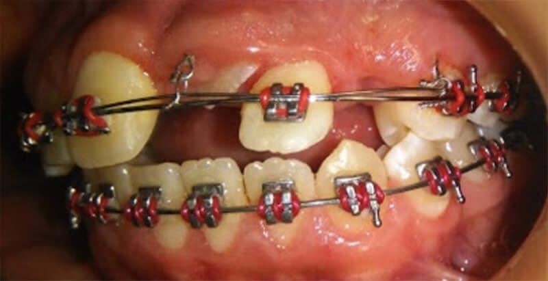 Fig. 11. Vista del doble arco utilizado para traccionar los dientes retenidos