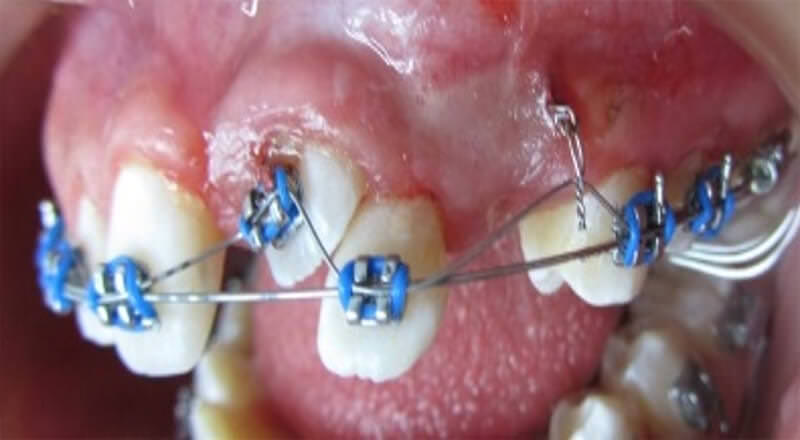 Fig. 12. Incisivo superior erupcionado hasta tercio medio.