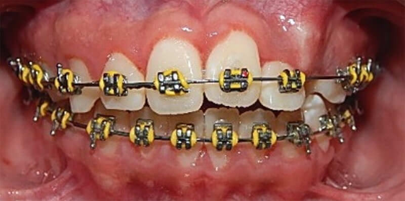 Fig. 13.  intraoral de frente con el incisivo llevado a su posición.