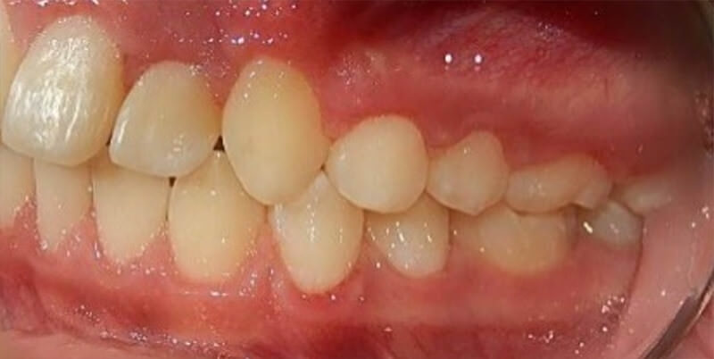 Fig. 17.  intraoral izquierda