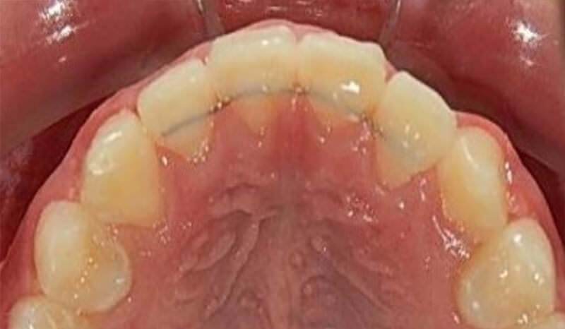 Fig. 19. Retenedor fijo superior