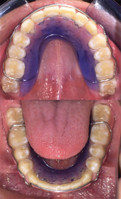 Fig. 20 Retenedores circunferenciales