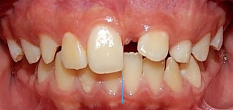 Fig. 3. intraoral de frente