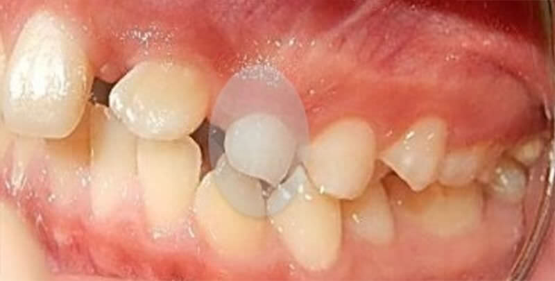 Fig. 4. intraoral izquierda