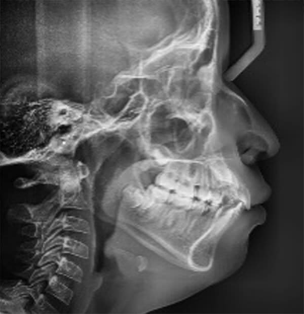 Fig. 6. Radiografía lateral de cráneo