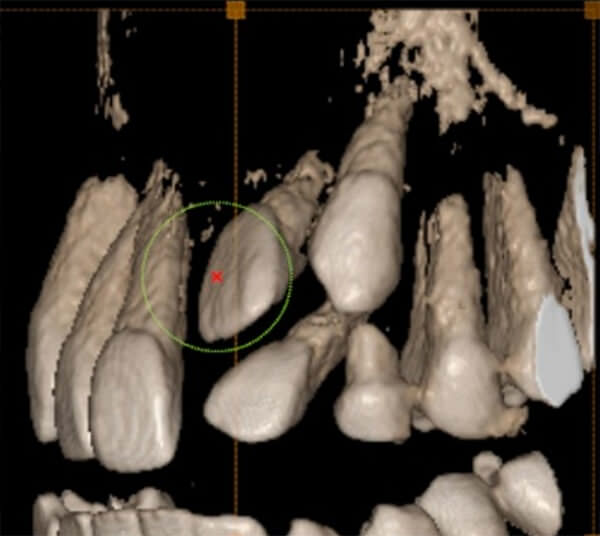 Fig. 7 3D superficie vestibular