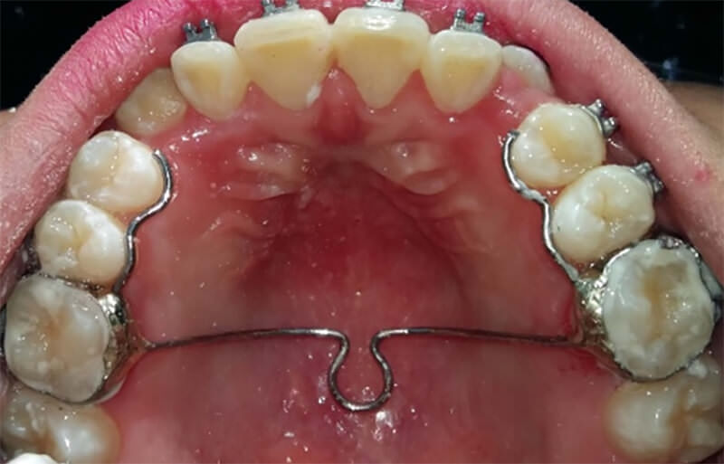 Fig. 10 Aparato de contención maxilar tipo Arco Transpalatino (ATP)