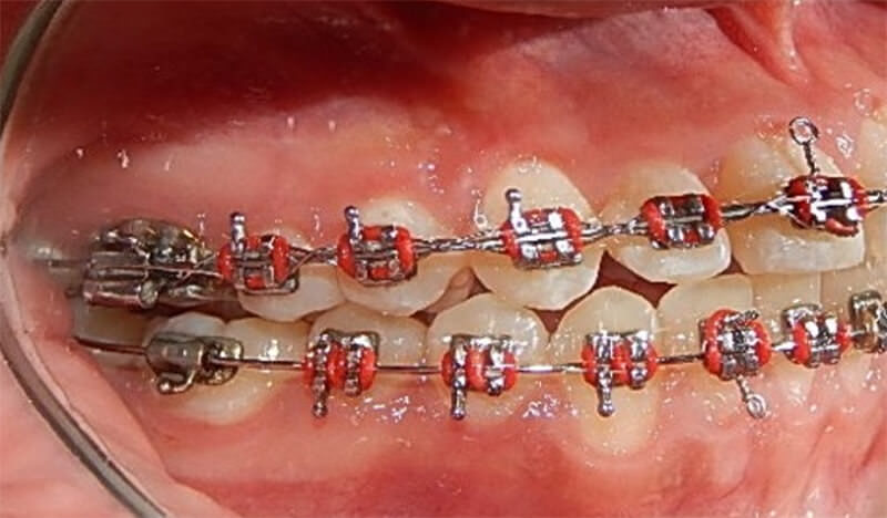 Fig. 11 Lateral derecha