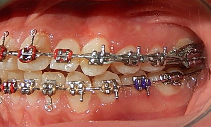 Fig. 13 Lateral izquierda