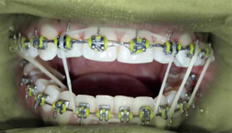 Fig. 14 Paciente con elásticos en caja anterior y cruzada en posterior