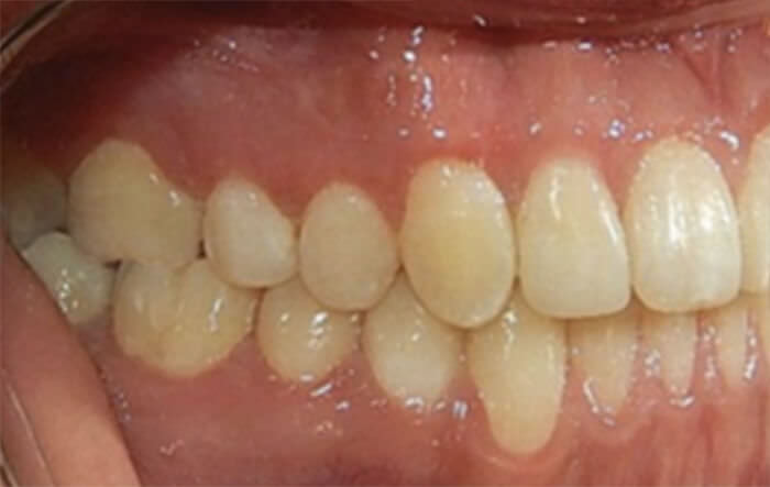 Fig.15 Intraoral lateral derecha