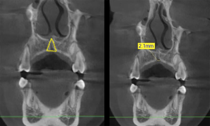 Fig. 19 Tomografía Cone Bean en corte coronal