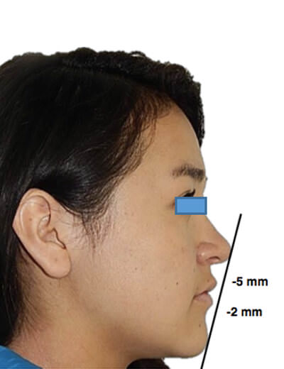 Figura 2 Extraoral de perfil