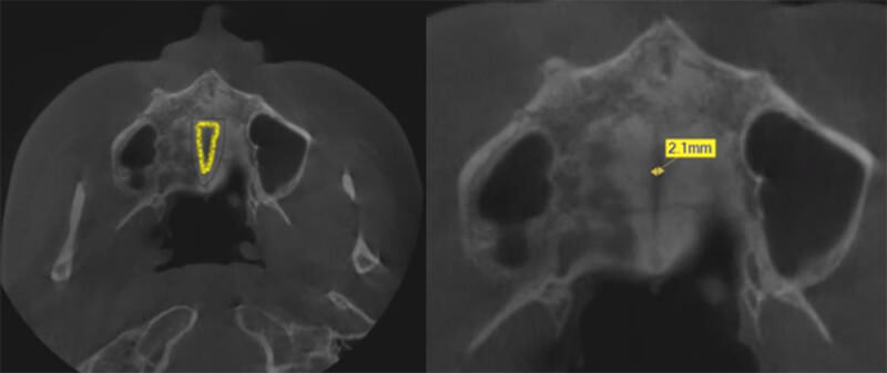 Fig. 20 Tomografía Cone Bean en corte axial