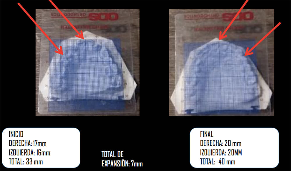 Fig. 21 Análisis de Ortómetro en donde se refleja la expansión lograda de 7mm