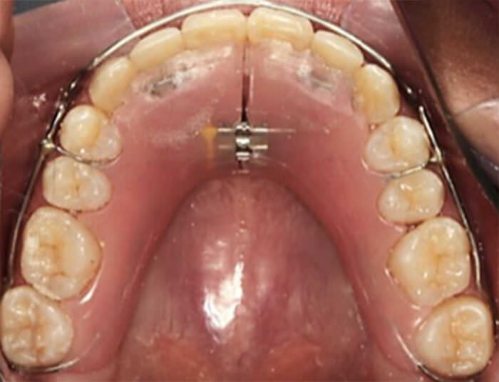 Fig.23 Retenedo superior